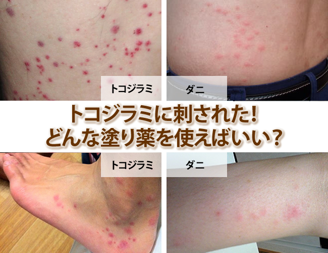 トコジラミによる咬傷と他の昆虫による咬傷の比較