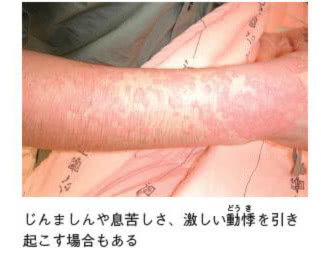 ヒアリの被害 ヒアリの被害